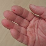 Verwundete Bürohände